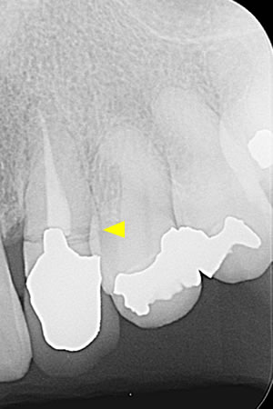 左の犬歯が途中で折れているレントゲン