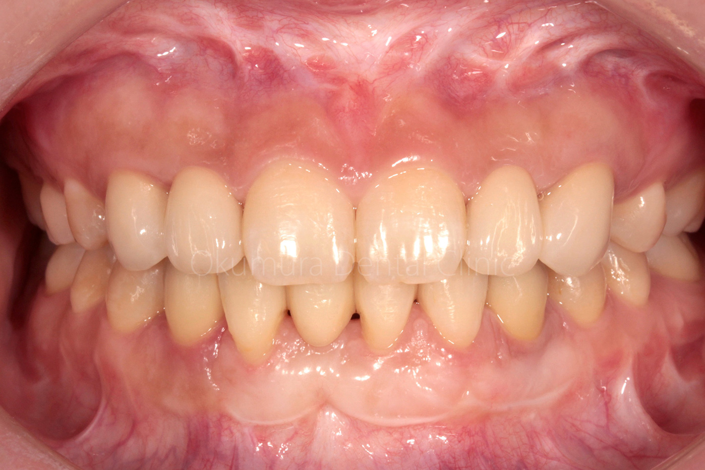 歯がない部分をインプラント治療して歯ぐきを強化