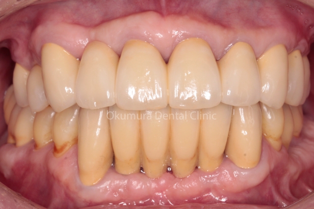前歯は歯ぐきの強化してオールセラミック