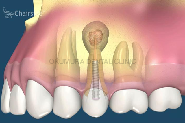歯の根の再治療ができないときのエンドドンティック・マイクロサージェリー